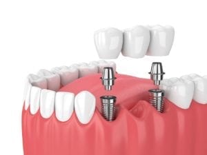 dental implants dentist payette id