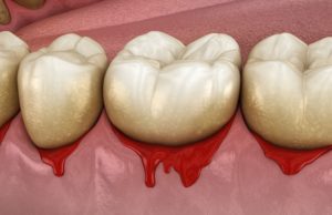 treat bleeding gums in Payette Idaho