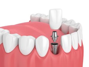 implant dentistry procedure Payette Idaho