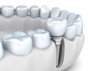 single dental implant in the jawbone