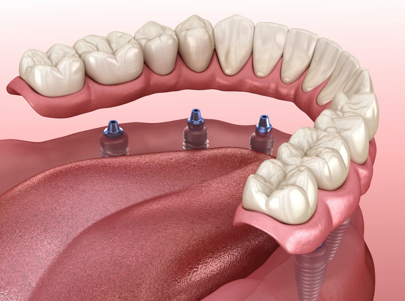 protect dental implants with dentist advice