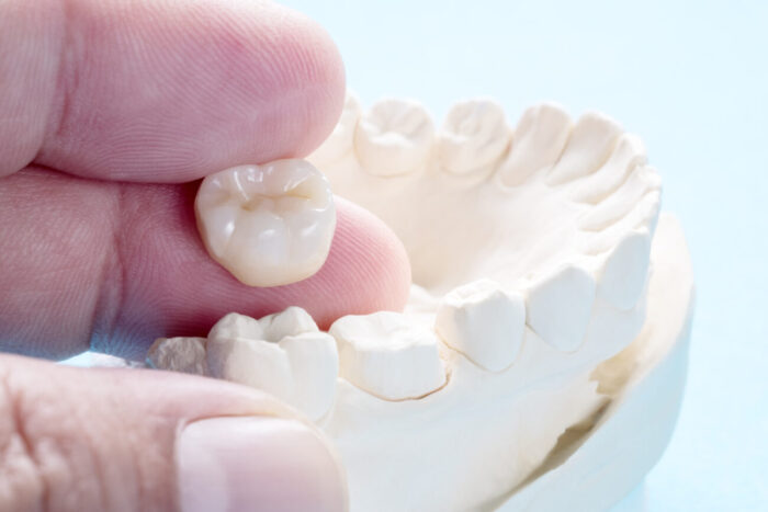 What to Consider Before Dental Crown Treatment
