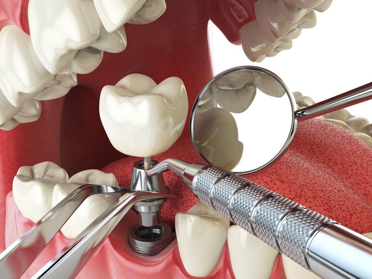DENTAL IMPLANTS in PAYETTE ID are often recommended for patients with missing teeth