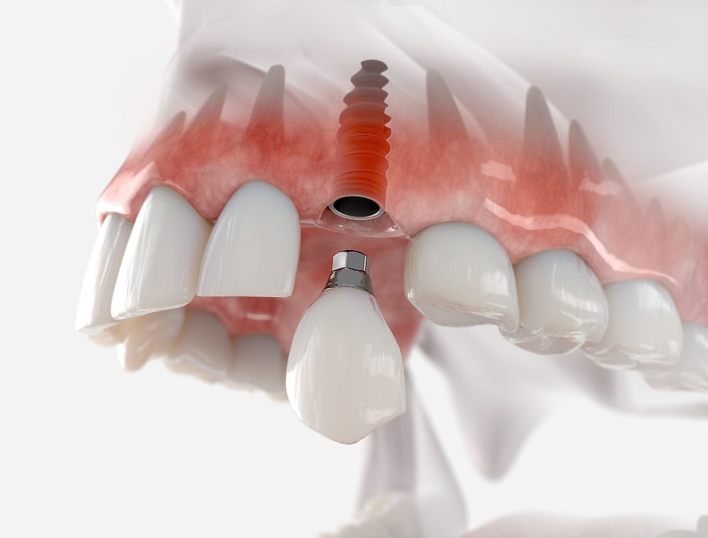 Dental implants could provide a permanent, sturdy replacement option mimicking the natural tooth root after tooth loss.