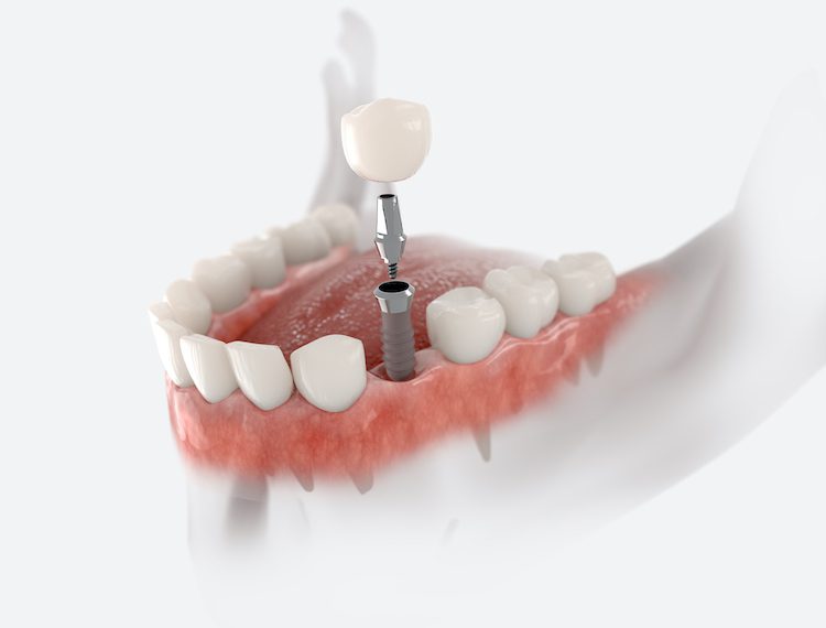 Unlike dentures or bridges, dental implants integrate with your jawbone, offering stability and durability.