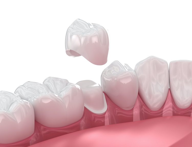 Understanding the signs you may need a dental crown can help you make informed decisions and seek timely care before problems worsen.